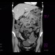 Crohn's disease, acute inflammation, ascites, CT enterography: CT - Computed tomography